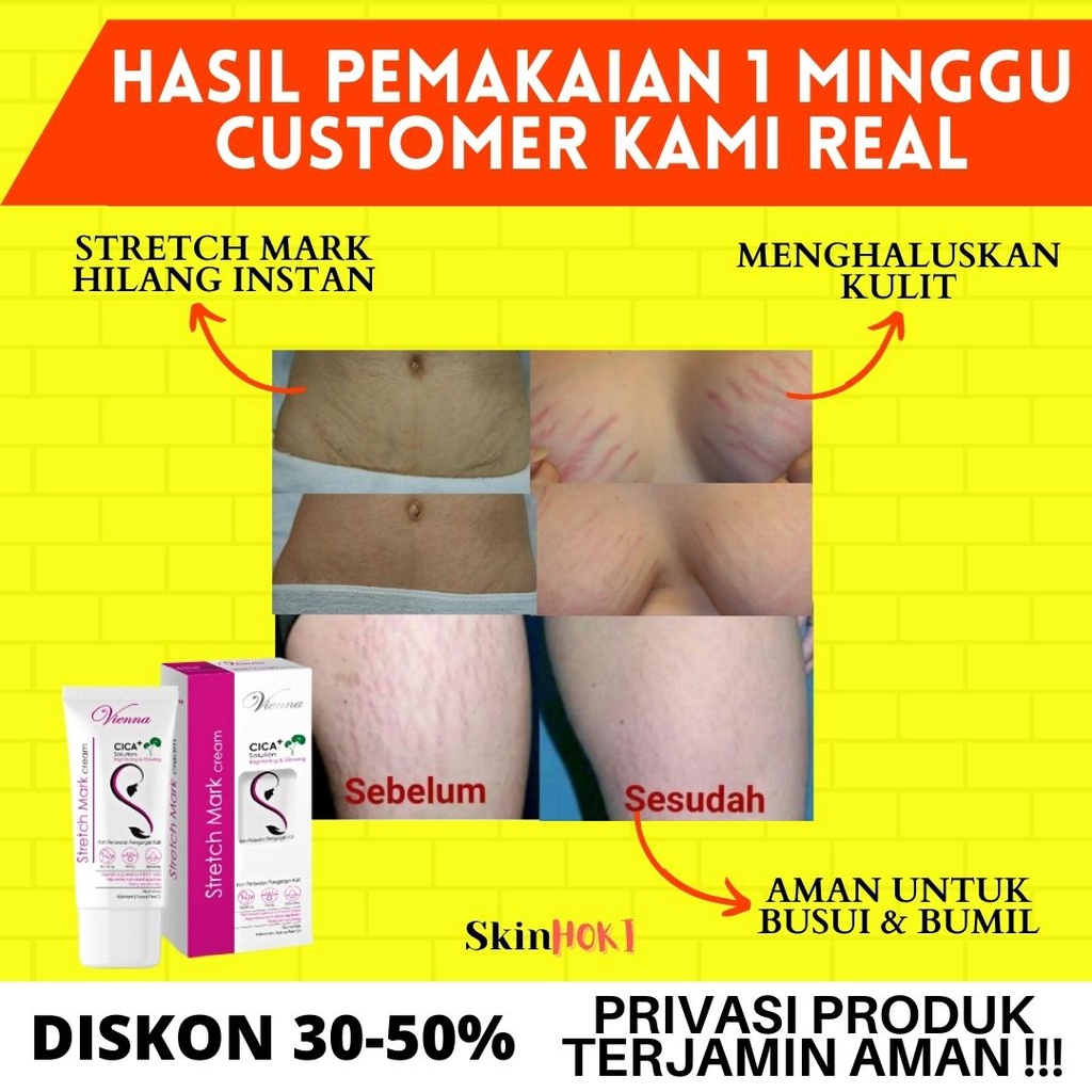 PENGHILANG STRETCH MARK PERMANEN AMPUH PENGHALUS KULIT VIENNA STRETCHMARK CREAM 80ML PERAWATAN KULIT ORIGINAL BPOM