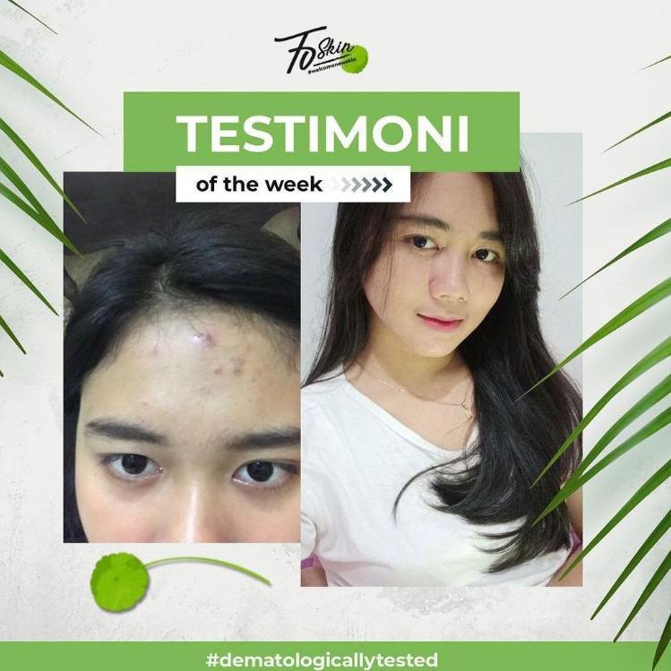 ㊊ 70SKIN ACNE SERIES / 70SKIN ACNE / 70SKIN HOT SALES 2994 ◘