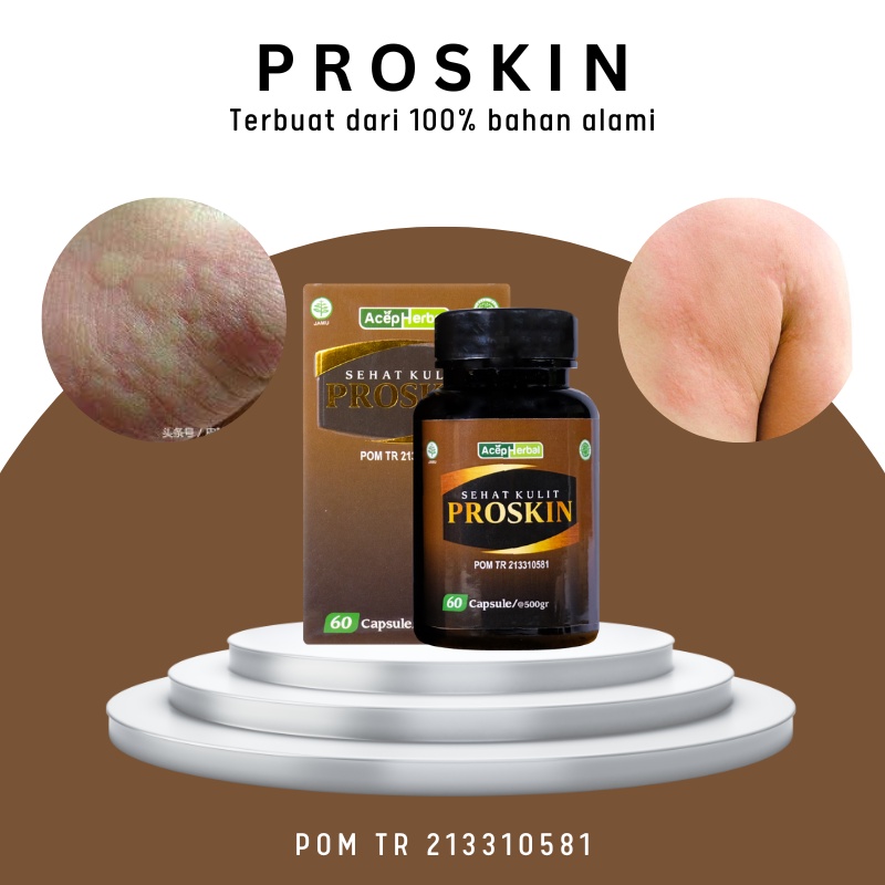 Kaka Herbal - Obat Biduran, Obat Kulit Gatal Kemerahan, Obat Gatal Anak Dan Dewasa, Obat Minum/Oles 