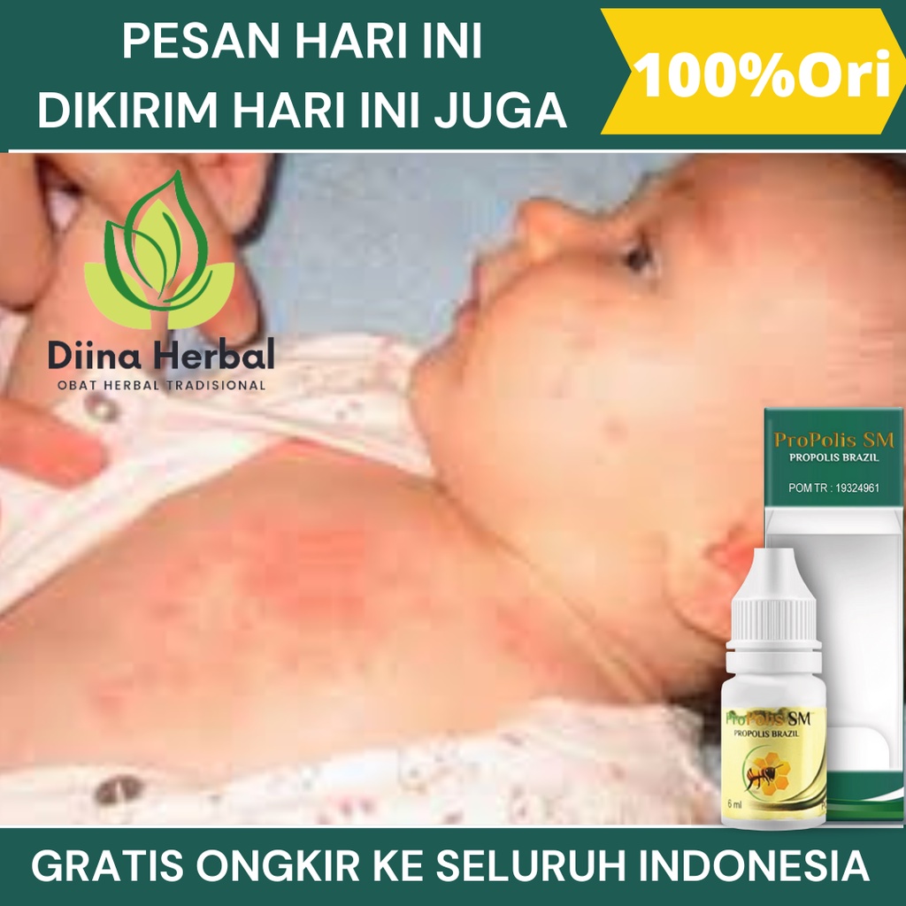 Obat Biang Keringat Dikulit Untuk Bayi, Anak Dan Dewasa, Obat Gatal Gatal dikulit, Obat Gatal Gatal 