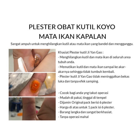 (COD)Plester mata ikan / Ji yan gao Garansi ori - Obat Kutil dan Mata ikan