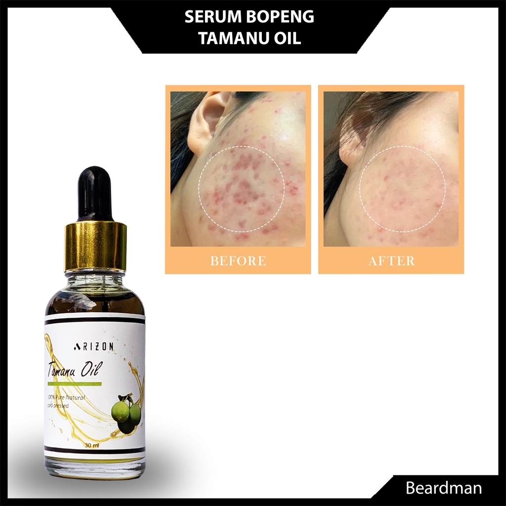ARIZON TAMANU OIL 100% MINYAK MURNI – Serum Kulit Wajah Untuk Mengatasi Bopeng Bekas Jerawat Pria Wa