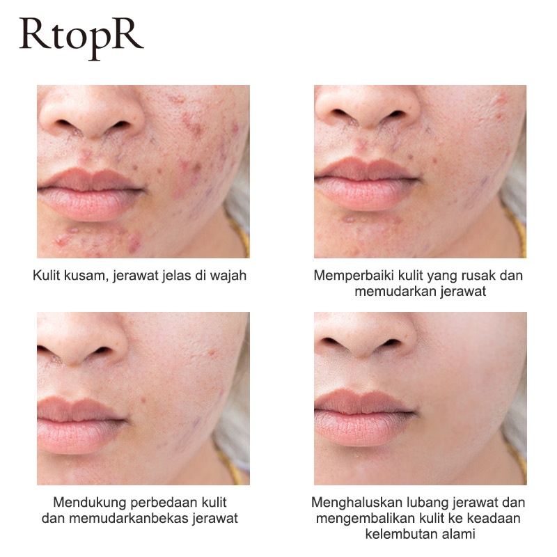 [BPOM]RtopR Propolis Perbaikan Jerawat Anti Jerawat Serum Pencerah Jerawat Bekas Jerawat Serum Pembersih Bintik-Bintik Bekas Jerawat Mengecilkan Pori-Pori Menghilangkan Jerawat Perawatan Minyak kontrol Jerawat 20ml