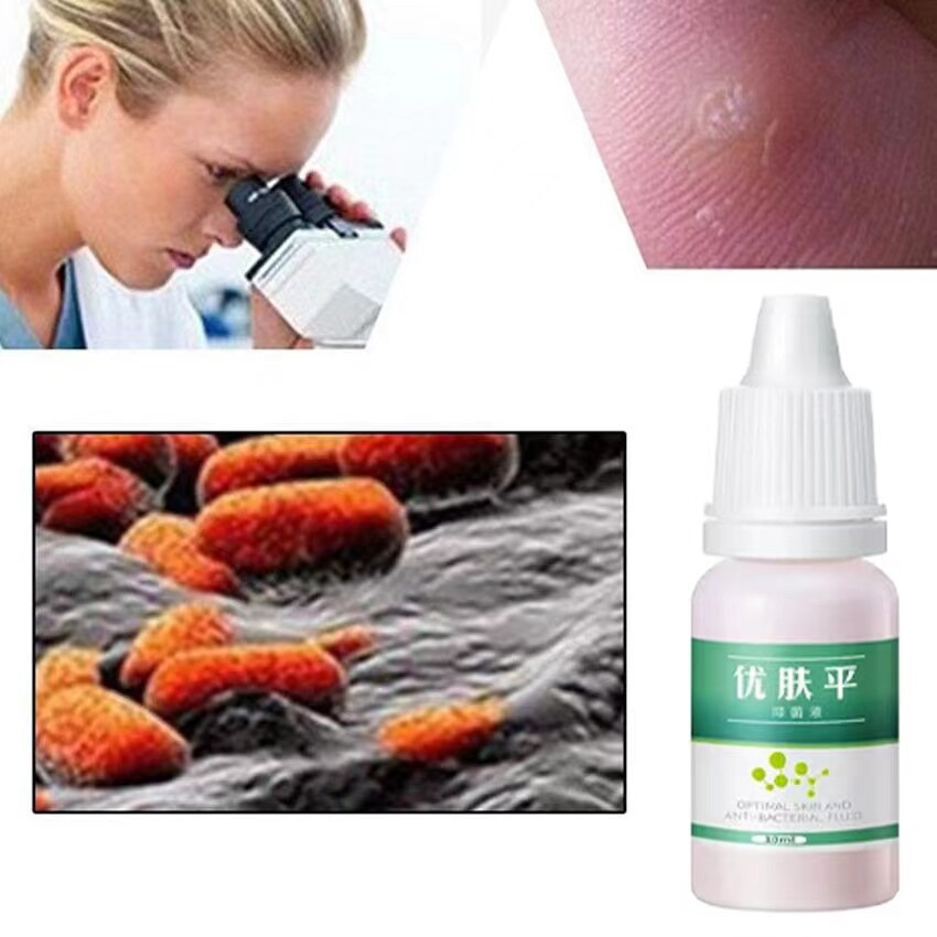 Obat mata ikan penghilang kutil Obat kutil kelamin 10ml Obat cair antibakteri kutil tangan dan kaki Menghilangkan Mata Ikan Di Kaki 100% Herbal Alami