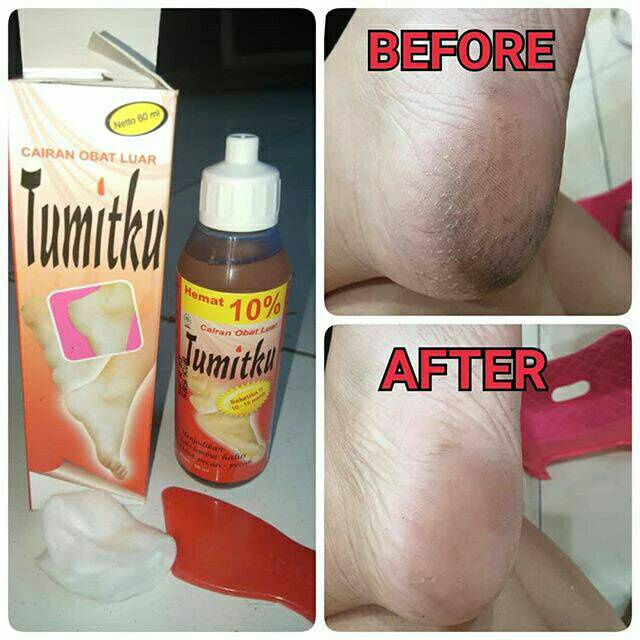 Perawatan Kaki Original Tumitku Obat Herbal Kaki Pecah Masker Kaki Efero Penghalus Pengelupas Kulit Mati Kaki Lebih Halus Lembut Pemutih Kaki Alat Gosok Tumit Kaki Penghalus Tumit Kaki Pecah Retak Kapalan Kaki