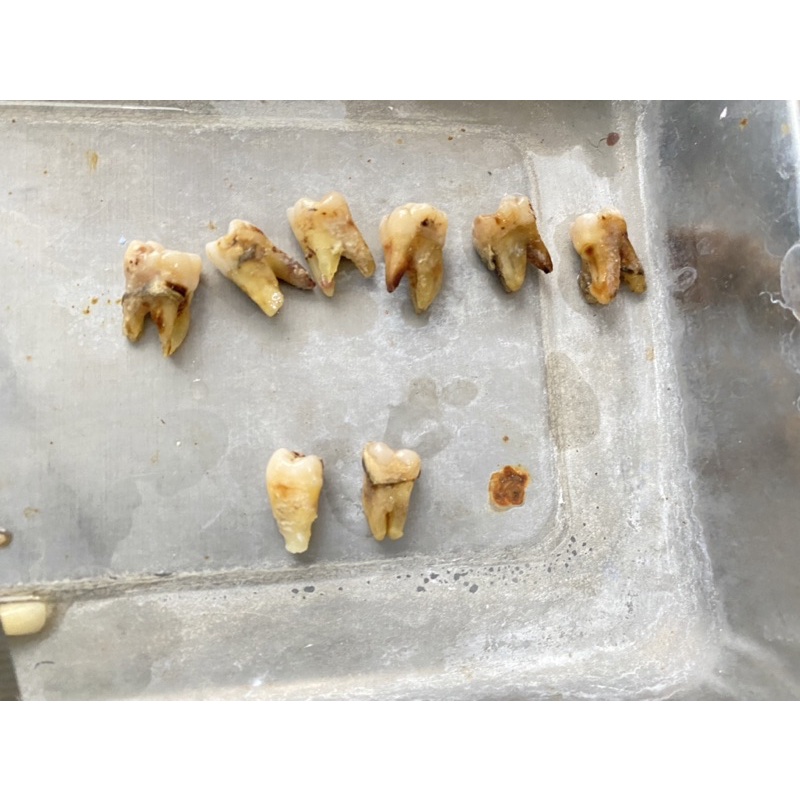 gigi molar rahang atas