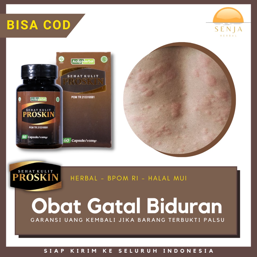 Obat Biduran, Obat Biduran, Obat Alergi Biduran, Obat Bentol Biduran, Obat Ruam Biduran | PROSKIN
