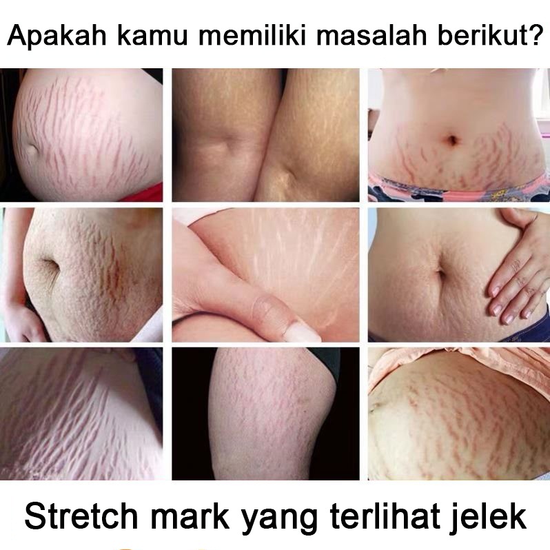 O'RANNLE Original StretchMark Cream Krim、Stretchmark Krim penghilang stretch mark (aman halal alami dirancang khusus untuk ibu hamil) Lotion stretch mark