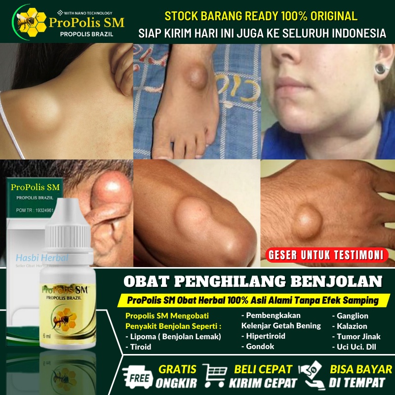 Obat Alami Penghilang Benjolan Abnormal di Punggung / Kaki / Leher / Daun Telinga / Lengan Tangan / 