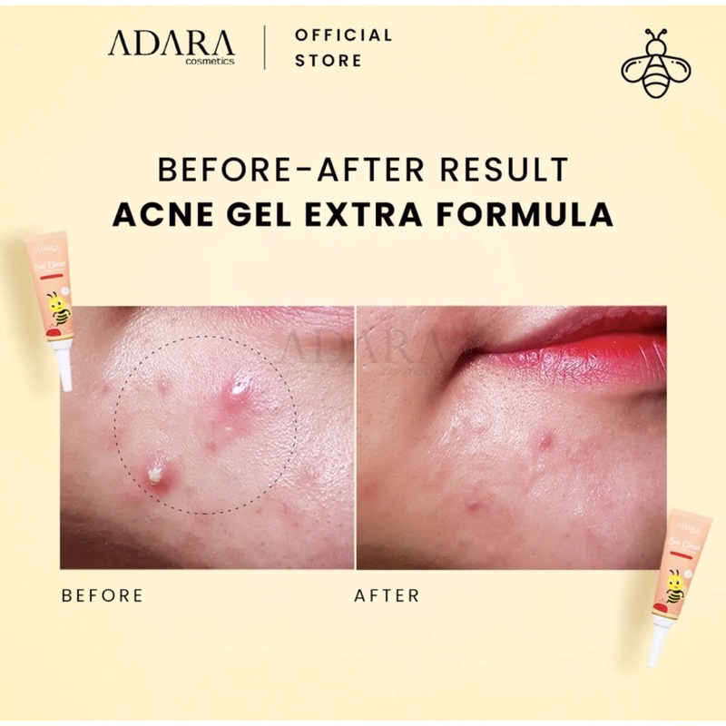 Adara - Bee Clear Acne Gel and Adara Gel Extra Formula