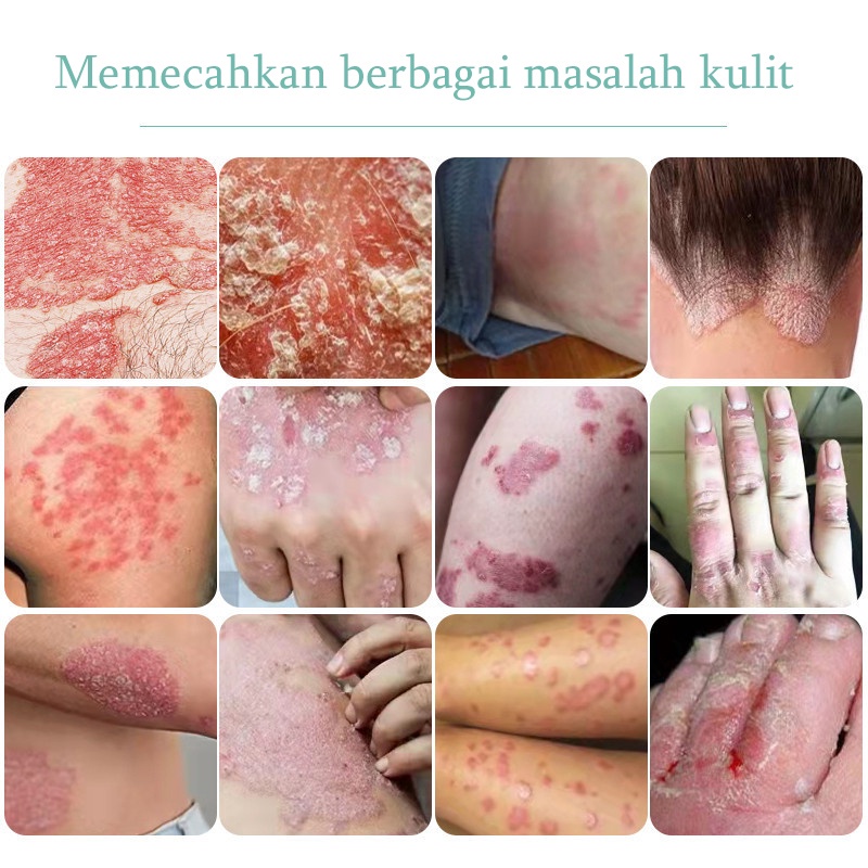 Salep gatal Obat gatal kulit Obat gatal selangkangan Obat kurap paling ampuh 20ML Menekan rasa gatal dan bau / menghilangkan kurap seluruh bagian tubuh / kurap tangan / kurap kaki / psoriasis / aman dan efektif