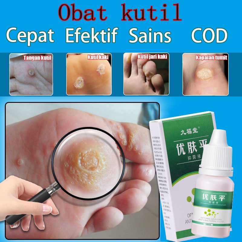 Cairan Obat Untuk Kutil Salep Untuk Kapalan Kaki Cairan Anti Kutil Tangan Dan Kaki Menghilangkan Kutil &amp; Skin Tag Cairan Antibakteri Obat Kutil 10ml Kapalan Di Tangan Dan Kaki Krim Antibakteri Penghilang Tahi Lalat