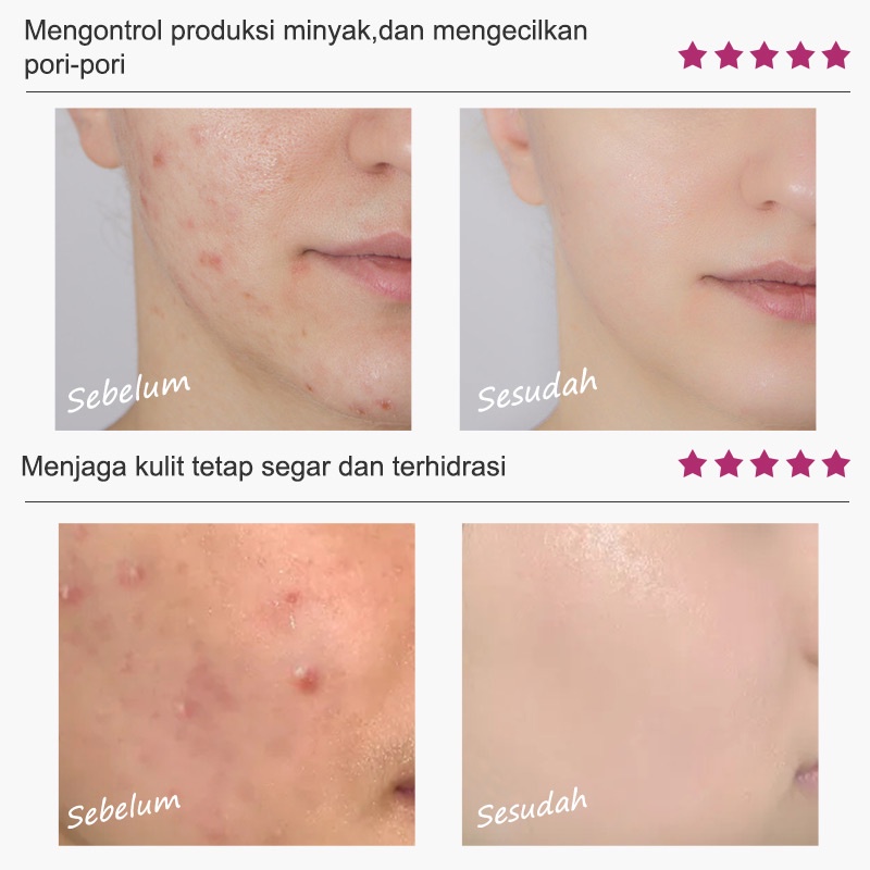 [BPOM]RtopR Propolis Perbaikan Jerawat Anti Jerawat Serum Pencerah Jerawat Bekas Jerawat Serum Pembersih Bintik-Bintik Bekas Jerawat Mengecilkan Pori-Pori Menghilangkan Jerawat Perawatan Minyak kontrol Jerawat 20ml