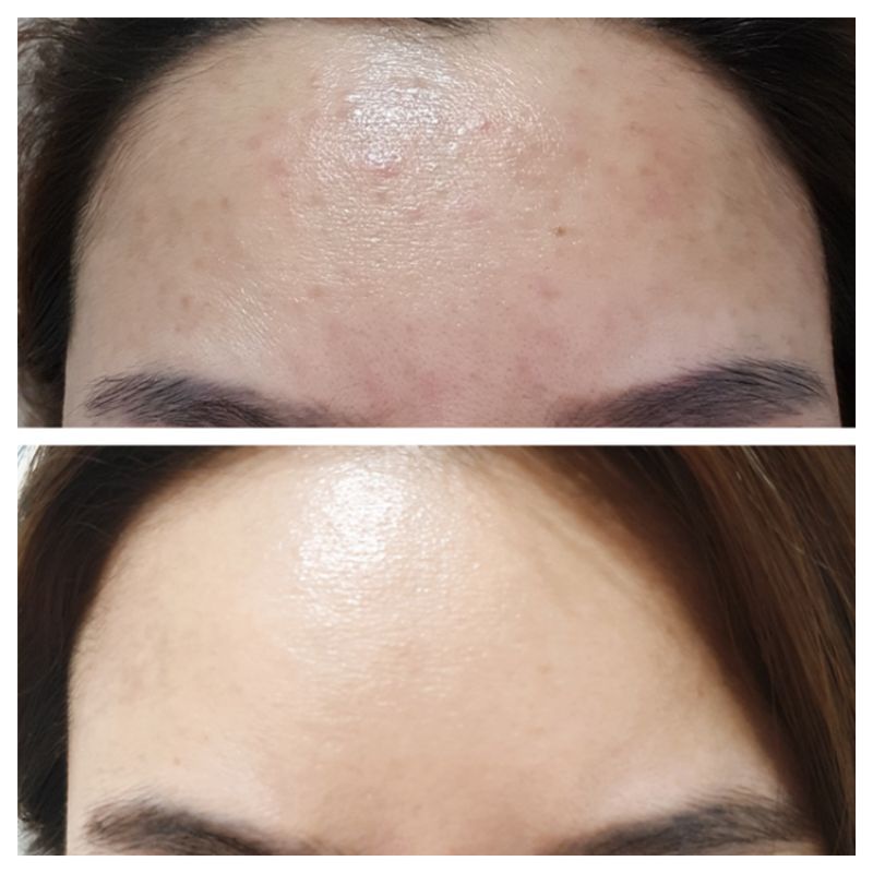 EIRA ACNE SET (3in1)