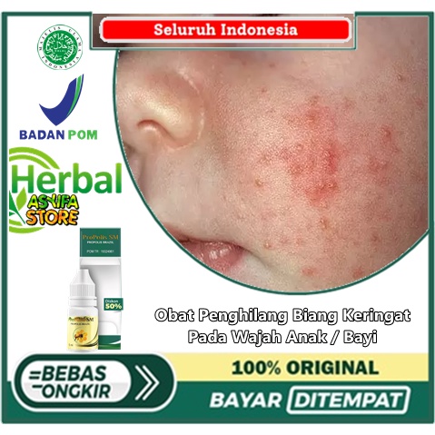 Obat Penghilang Biang Keringat Pada Wajah Anak / Bayi - Obat Keringat buntet | Bintik Merah Gatal - 