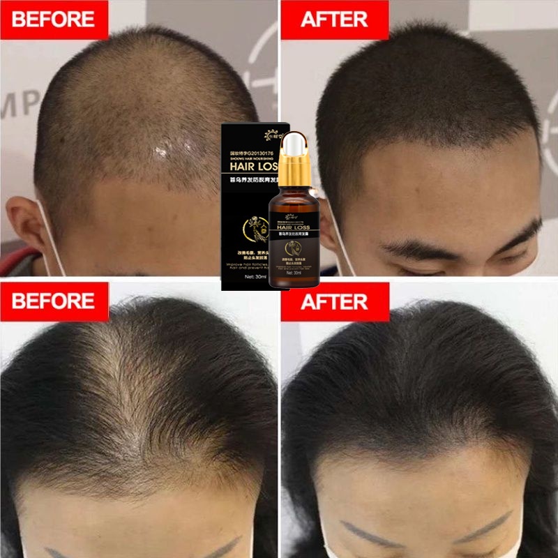 Penumbuh rambut botak Serum rambut rontok 30ml Penumbuh rambut cepat Kontrol minyak Menyuburkan rambut Mencegah Kebotakan-3