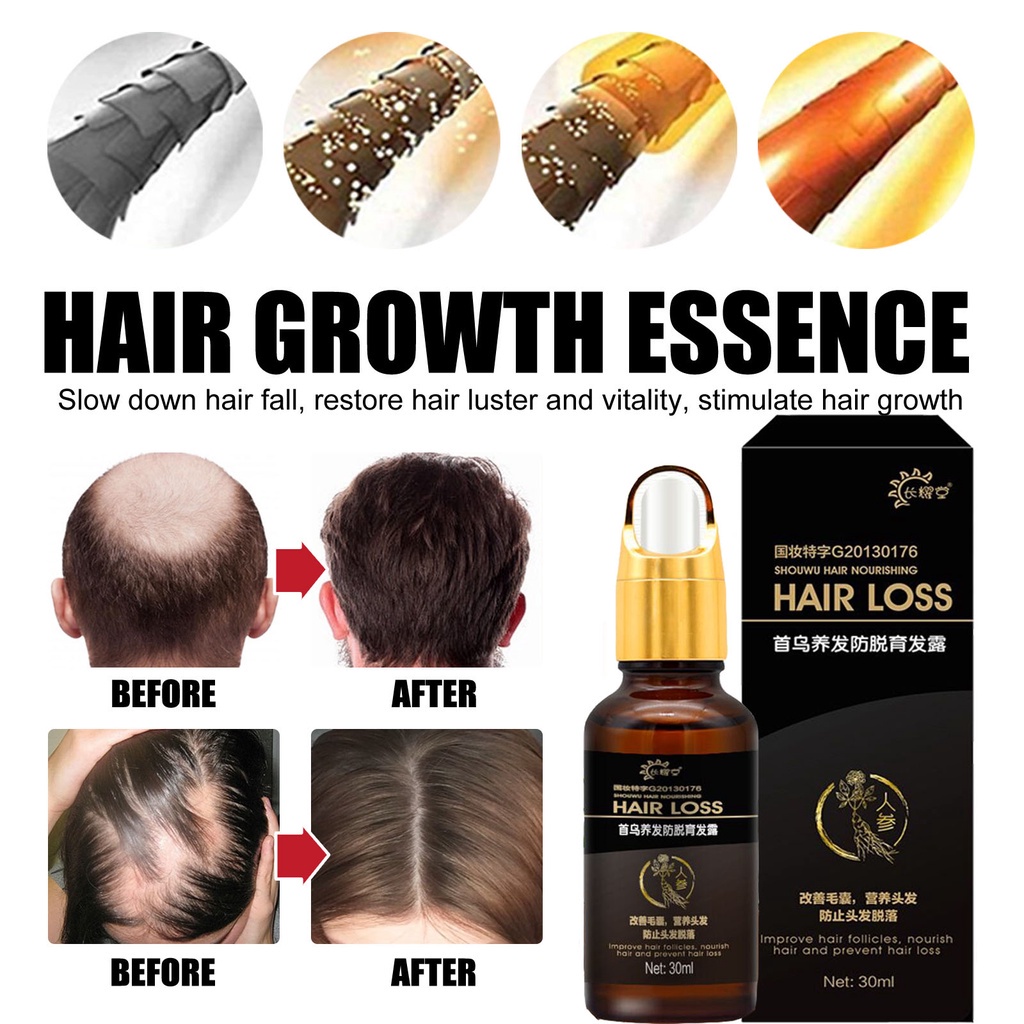 Penumbuh rambut botak Serum rambut rontok 30ml Penumbuh rambut cepat Kontrol minyak Menyuburkan rambut Mencegah Kebotakan-5