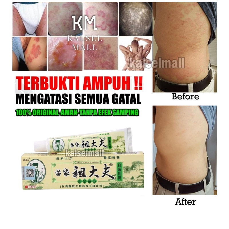 Salep Obat Salap Cream Krim Gatal 100% ORIGINAL Zudaifu Herbal Cina Untuk Alergi Gatal Kulit Jamuran Jerawat Eksim Psoarisis Kudis Panu Kurap Panuan Skabies Eksim Jamur Kutu Air Kurapan Keputihan Selangkangan Herpes Gatalan Zhudaifu Zudaipu Judaifu OC1