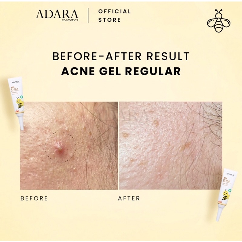 Adara - Bee Clear Acne Gel and Adara Gel Extra Formula