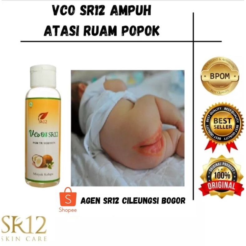 minyak vco / oil / sr12 /  Obat Ruam Popok Ampuh untuk Bayi - Obat Ruam Bayi - Obat Ruam Popok - Oba