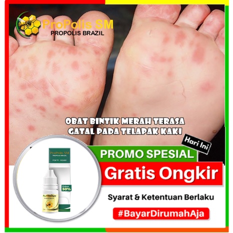 Obat Bintik Merah Terasa Gatal Pada Telapak Kaki | Penghilang Eksim Atau Dermatitis Dishidrotik, Kud