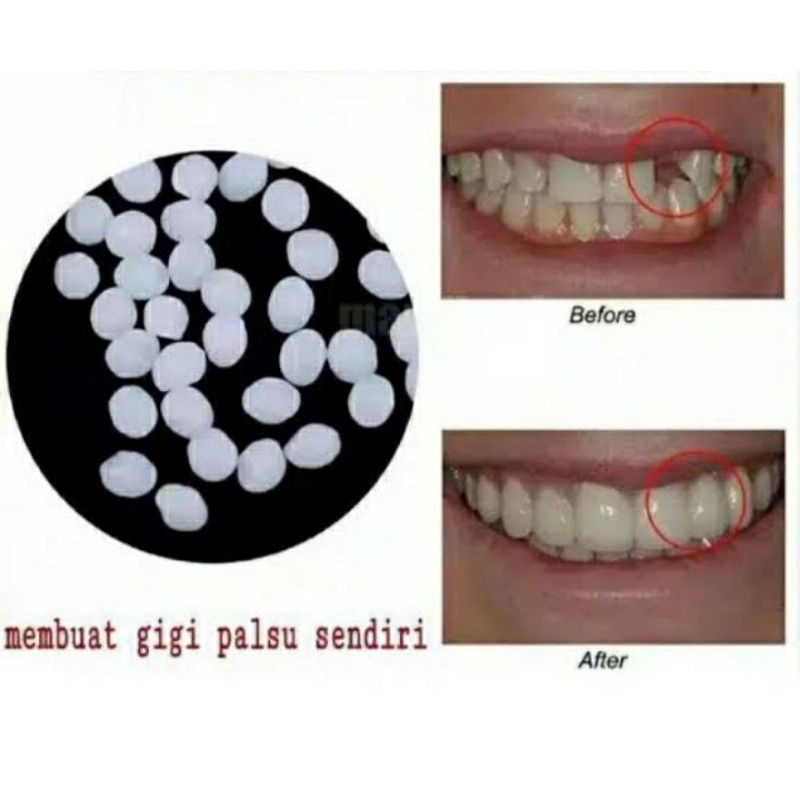 penambal gigi / tambal gigi sendiri / temptooth
