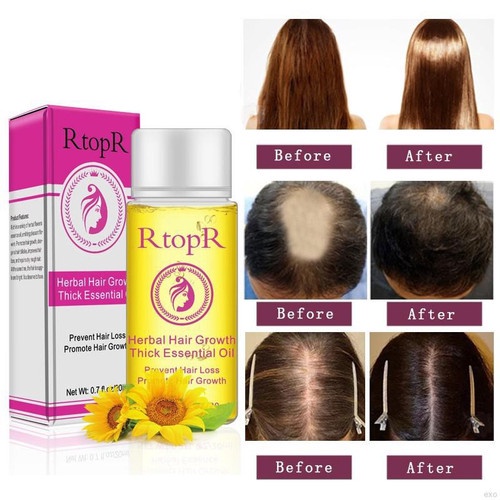 RtopR Herbal Hair Growth Thick Essential Oil Produk Pertumbuhan Rambut Minyak Esensial/RtopR Herbal Hair Growth Thick Essential Oil