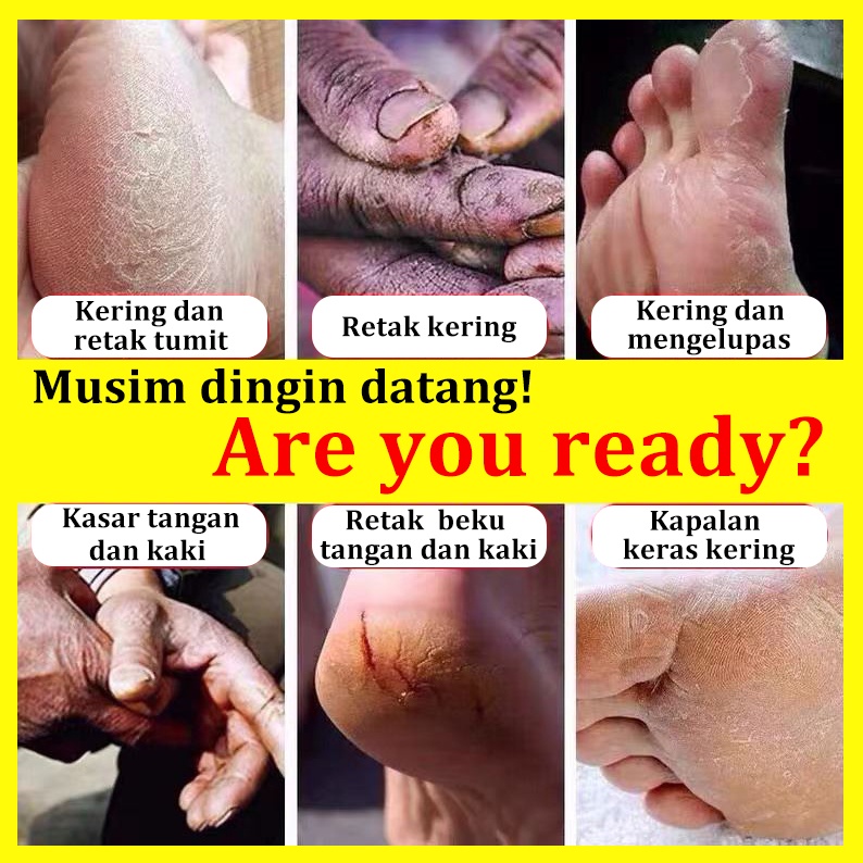 Anti pecah-pecah Krim kaki Krim tangan Tahan retak Minyak Kuda Tangan dan Kaki Retak Tumit Kering Retak Tumit Retak Anti Retak Perawatan Kaki Krim Penyembuhan