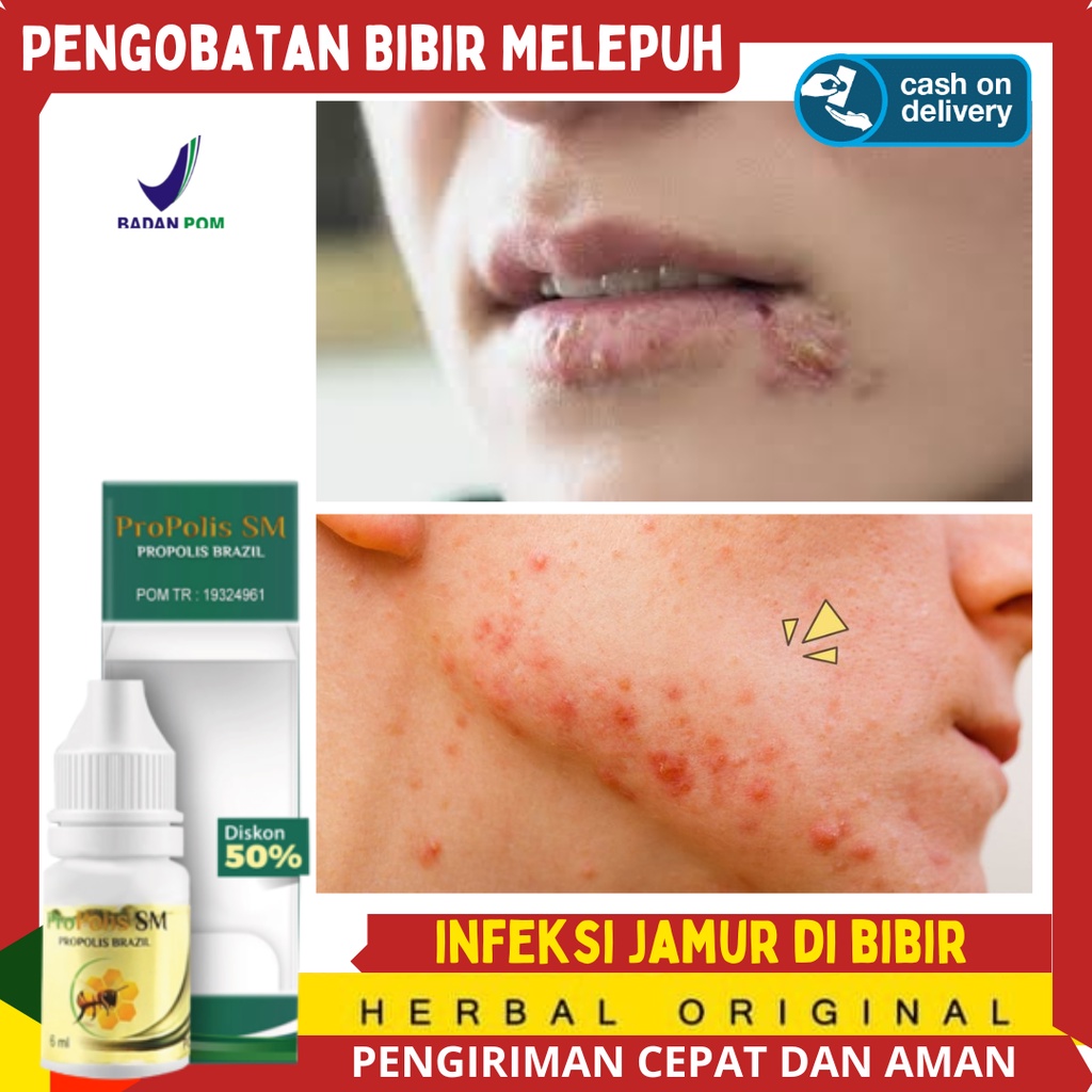 Pengobatan Bibir Melepuh - Dermatitis di area mulut - Obat Oles Gatal-Gatal di Bibir - menghilangkan