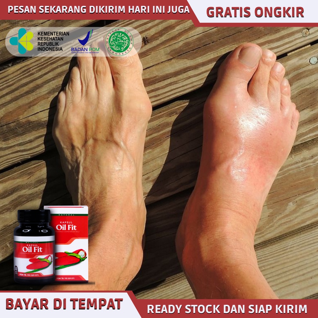 Obat kaki bengkak , obat pembengkakan kaki, obat kaki bengkak keseleo, obat nyeri kaki, obat herbal 