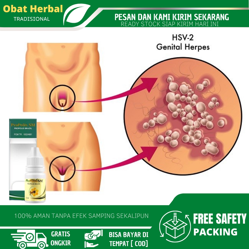 Obat Herpes di Kelamin, Herpes Kelamin Pria/ Wanita, Obat Herpes Simplex, Obat Gatal Kelamin, Obat I