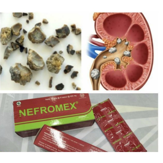 Nefromex kapsul Herbal alami penghancur batu ginjal ampuh STRIP