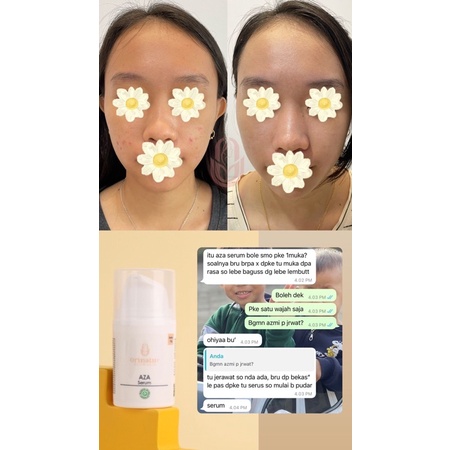 Serum  AZA Anti Jerawat dan Bekas Jerawat PIE & PIH