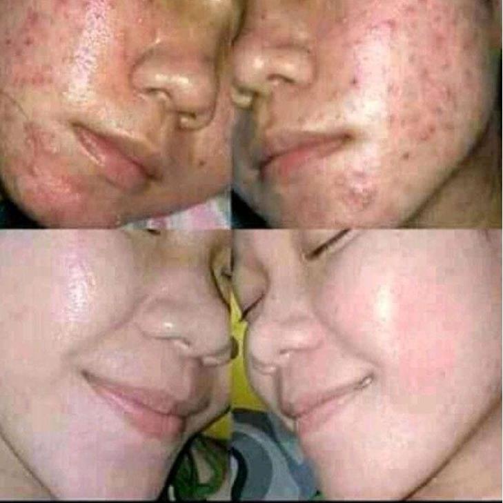 11.11✔️CHITA OIL ( PENGHILANG FLEK HITAM, BEKAS JERAWAT, PORI PORI DLL) 100% ORIGINAL HERBAL ALAMI|K