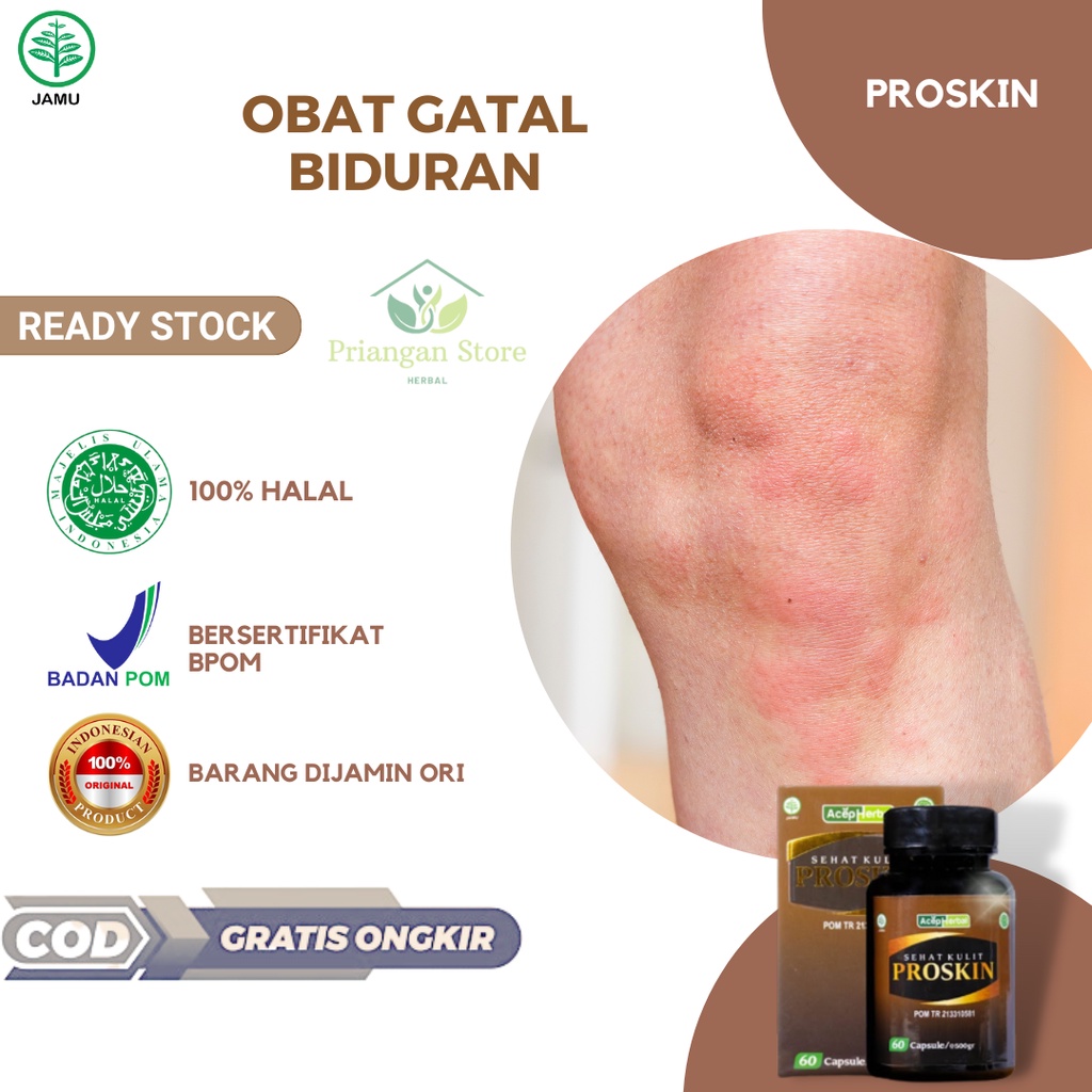 Obat Gatal Biduran Gatal Bintik Bintik Merah Kulit Bentol Bentol Biduran Menahun Gatal Alergi Alergi