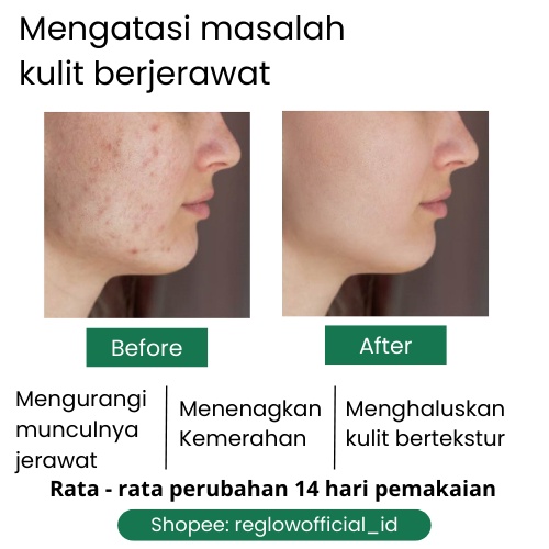 CREAM ACNE Reglow dr Shindy Putri Krim Jerawat Skincare Untuk Kulit Berminyak Berjerawat Dan Bruntusan Pelembab Moisturizer Siang Malam Reg glow Original Official Store