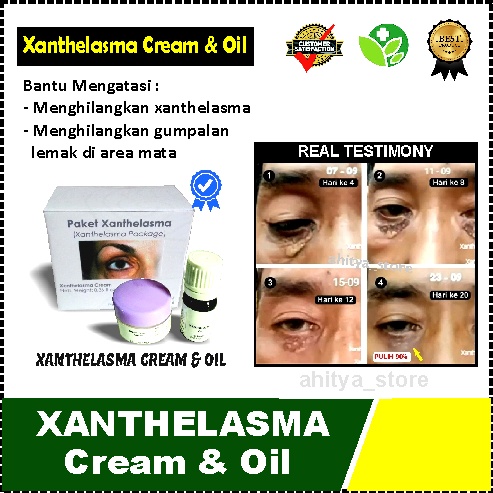 Jual Xanthelasma Cream Penghilang Gumpalan Lemak Di Kelopak Mata