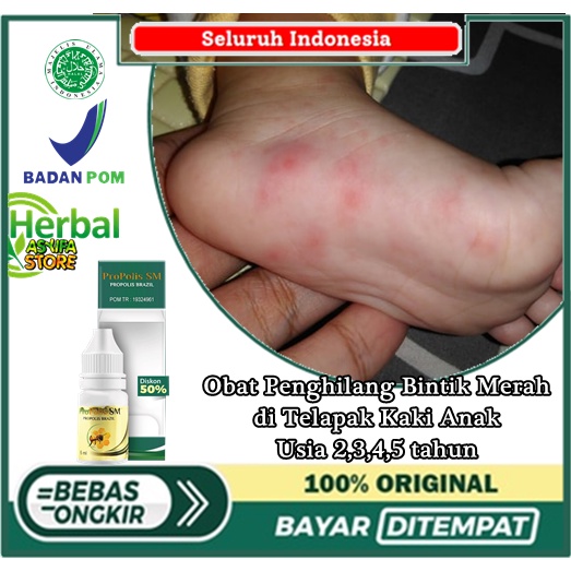 Obat Penghilang Bintik Merah di Telapak Kaki Anak Usia 2,3,4,5 tahun | Gigitan Nyamuk - Dermatitis K