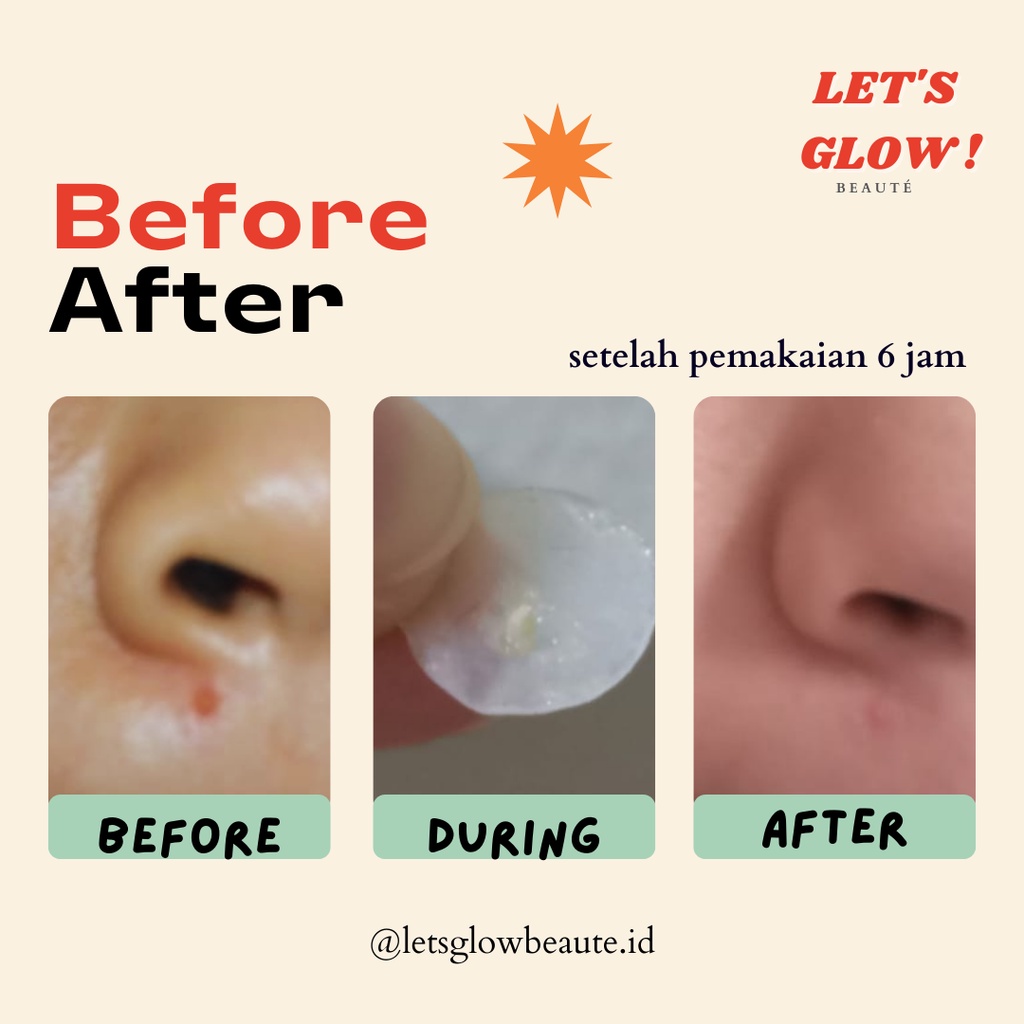 [PROMO] KOMBO HEMAT BUNDLING INFINITY + COLORFUL ACNE PATCH LETS GLOW GROUP