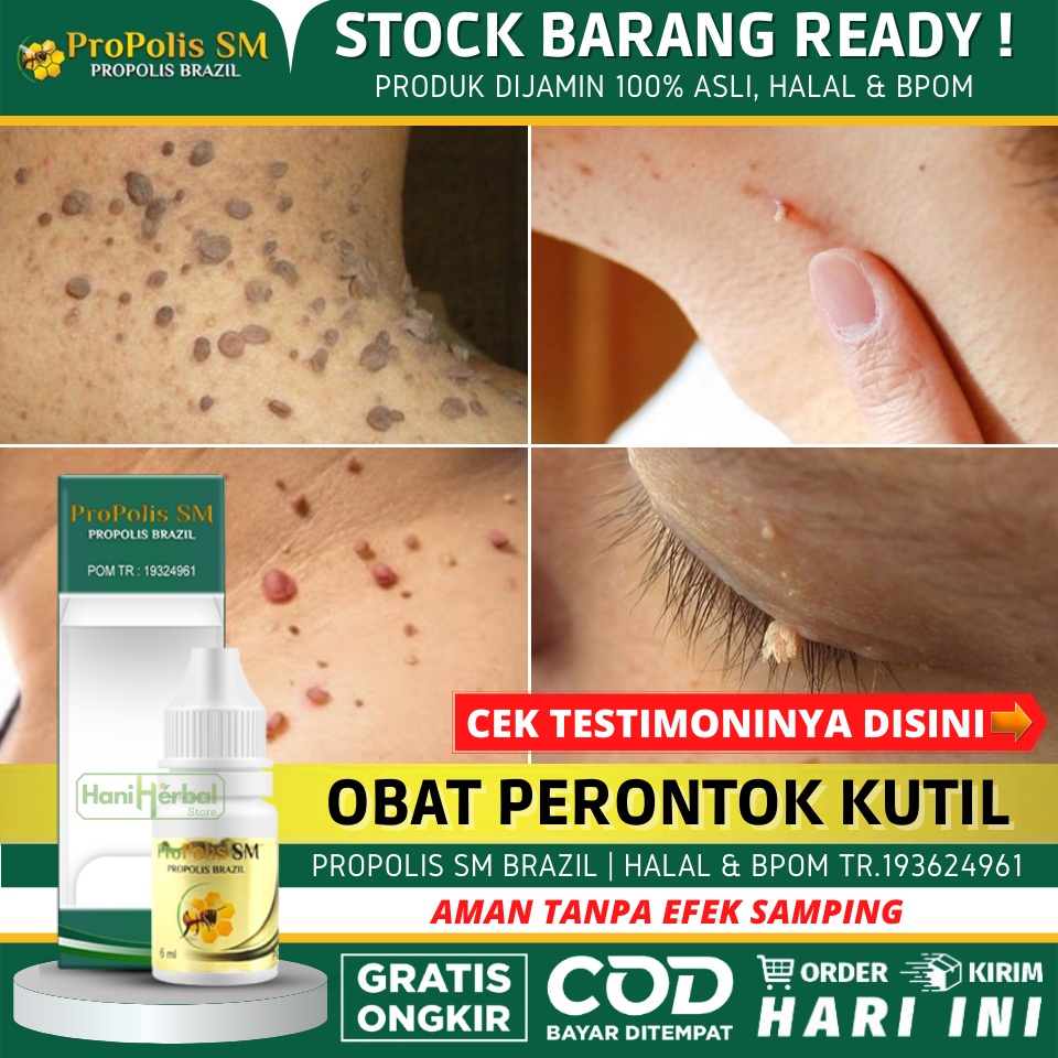 Obat Alami Untuk Menghilangkan Kutil, Virus Kutil Di Tangan, Leher, Wajah, Kaki, Kepala, Gusi, Jari,