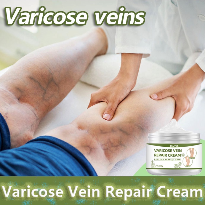 Obat varises Varises Cream50g Efektif Permanen Krim Varises Cream Varises Angiitis Salep Flebitis Ka