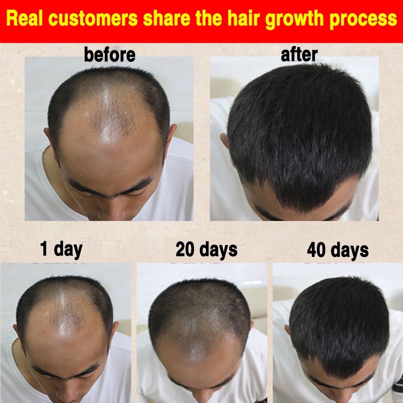 Penumbuh rambut botak Serum rambut rontok 30ml Penumbuh rambut cepat Kontrol minyak Menyuburkan rambut Mencegah Kebotakan-6