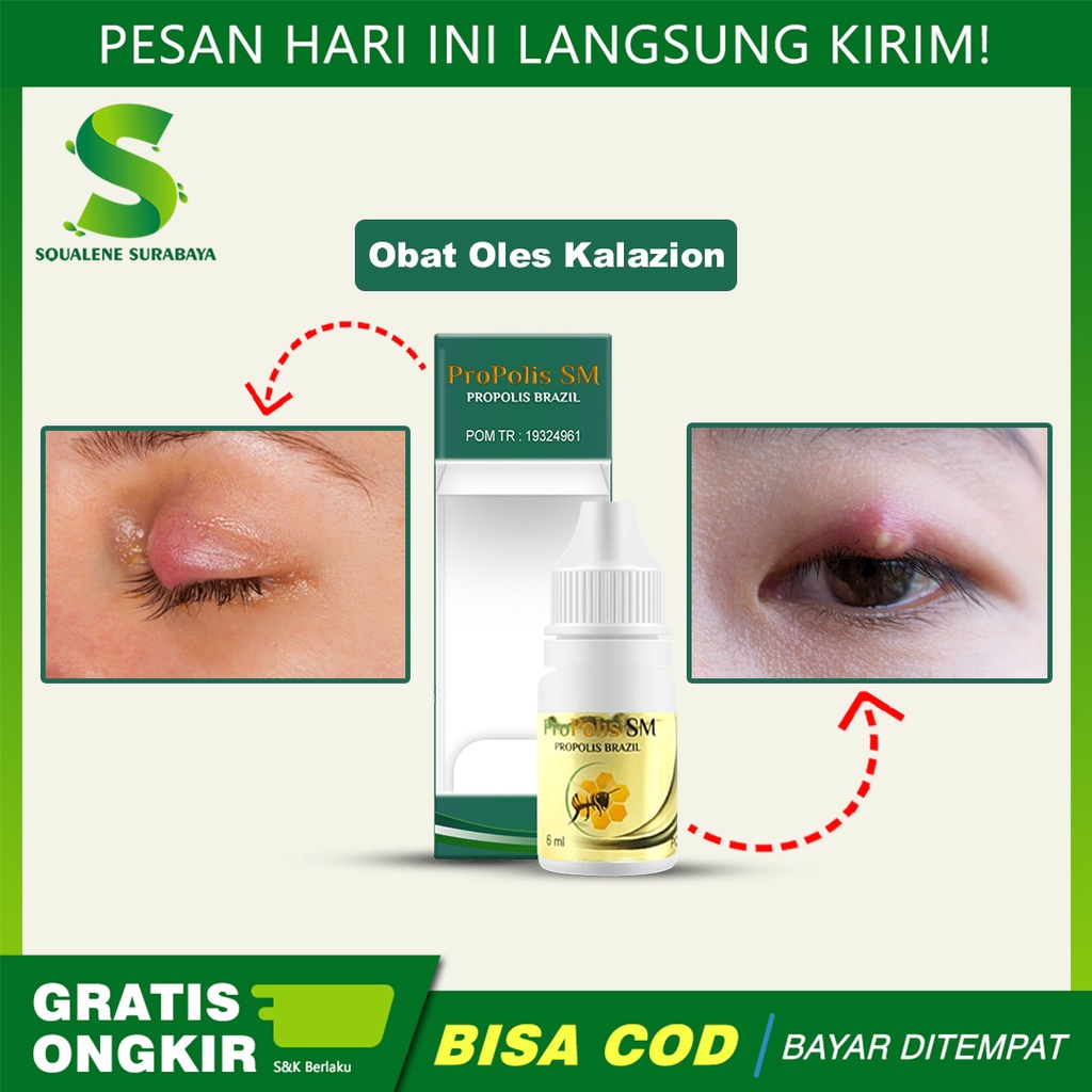 Jual Obat Mata Kalazion - Mata Bintitan - Benjolan Di Kelopak Mata ...