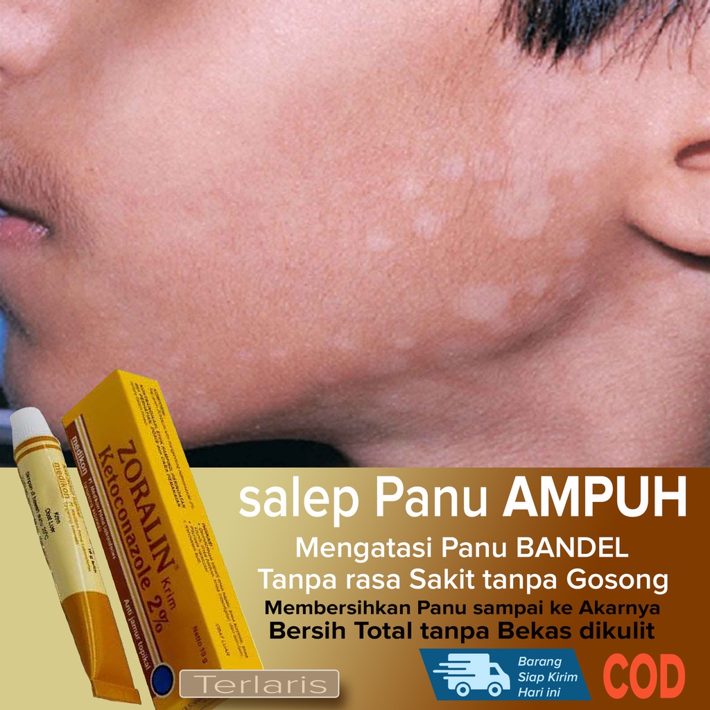 BEST SELLER salep Obat Panu BANDEL Ampuh Membersihkan Jamur Panu sampai ke Akarnya Membersihkan Gata
