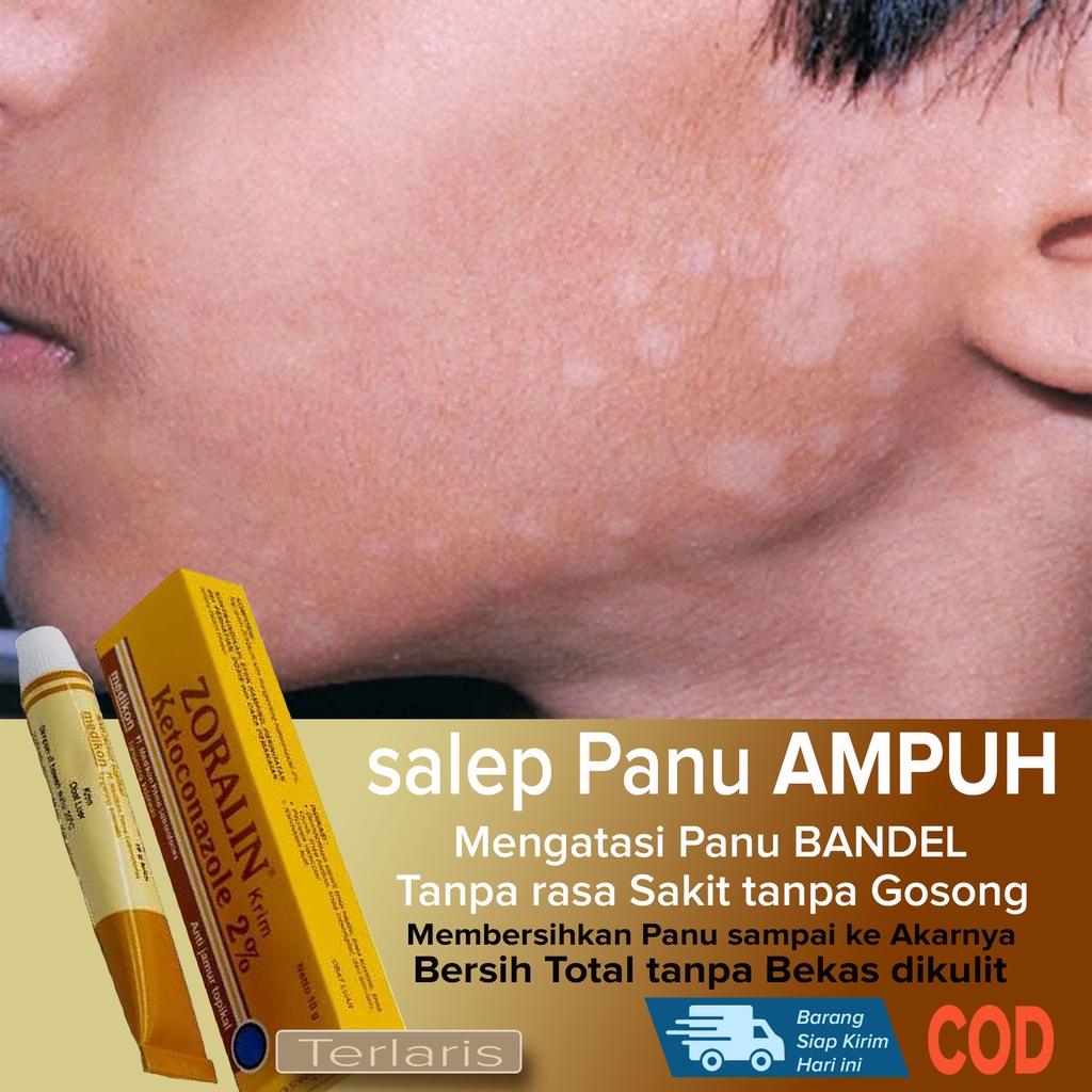 Jual Best Seller Salep Obat Panu Bandel Ampuh Membersihkan Jamur Panu Sampai Ke Akarnya 8284