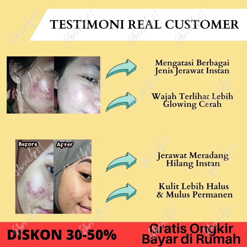 SABUN KHUSUS WAJAH DAN TUBUH BERJERAWAT QM FACIAL SOAP FOR ACNE SKIN BPOM - SABUN QM ANTI ACNE