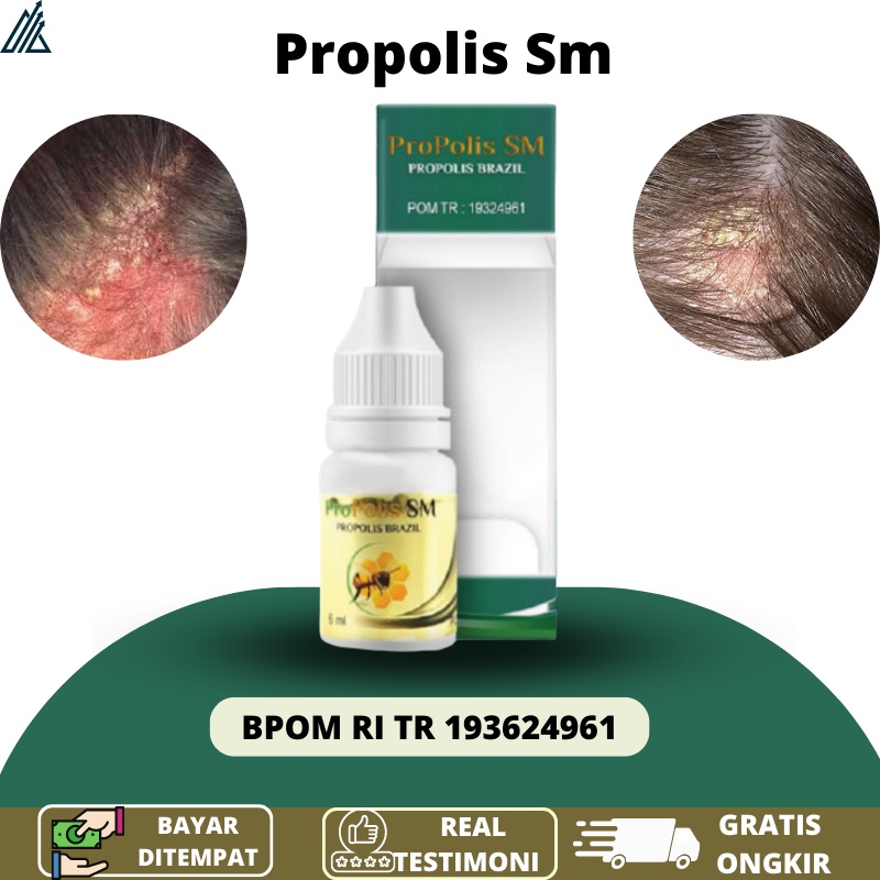 Obat Herbal Ketombe Parah Menahun, Obat Ketombe Parah, Obat Kulit Kepala Berkerak, Obat Ketombe Berk