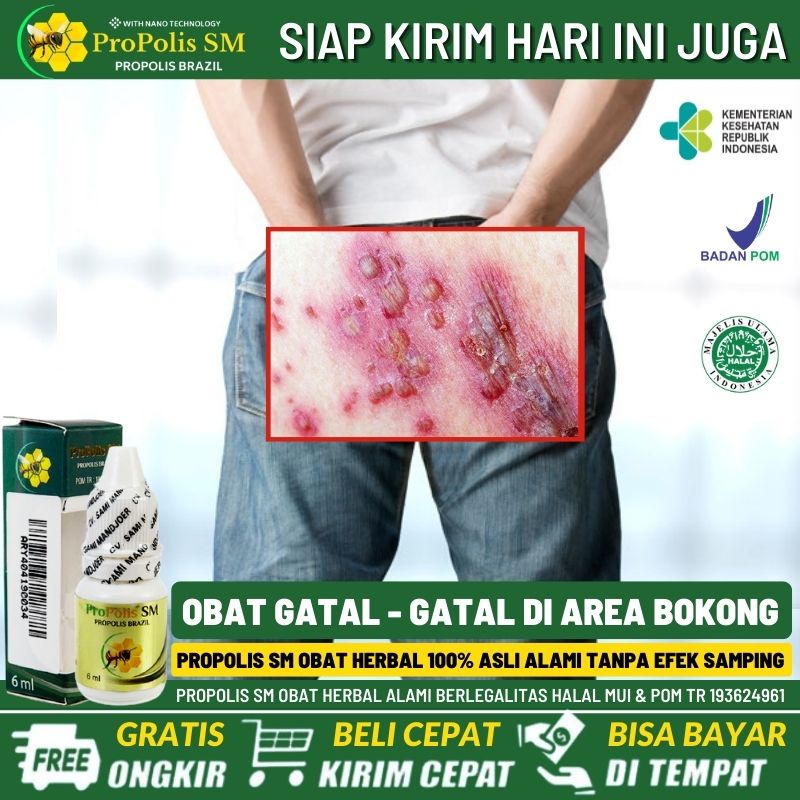 Salep Alami Penghilang Korengan di Pantat, Obat Gatal di Pantat, Borok di Pantat, Bruntusan Bentol -