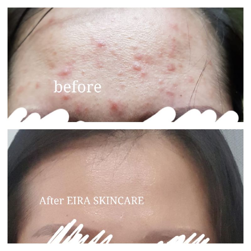 EIRA ACNE SET (3in1)
