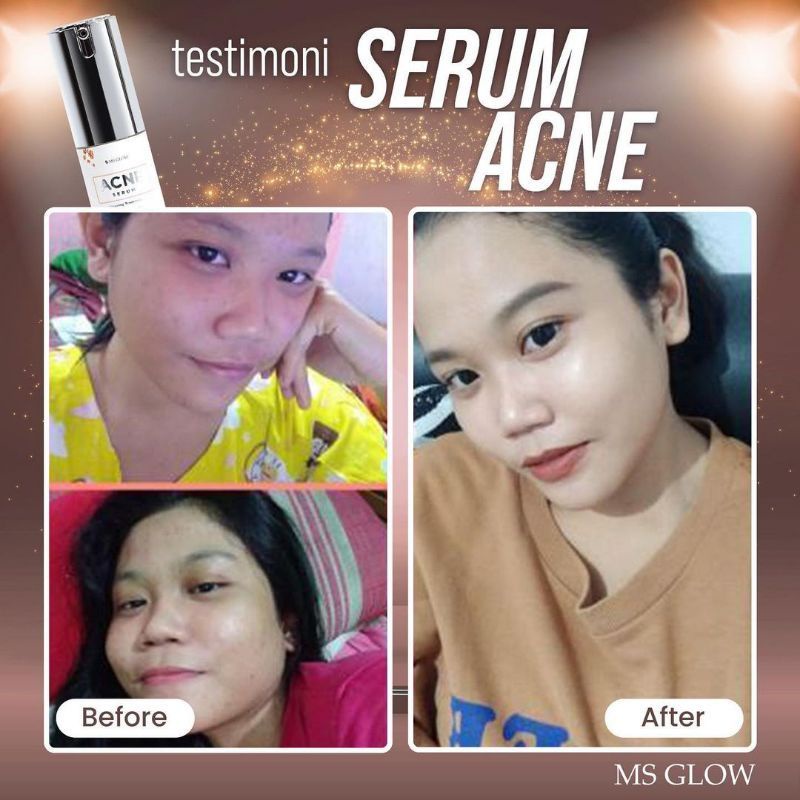 PAKET WAJAH ACNE + SERUM ACNE FREE ACNE SPOT MS GLOW ORIGINAL (SUDAH BER BARCODE)